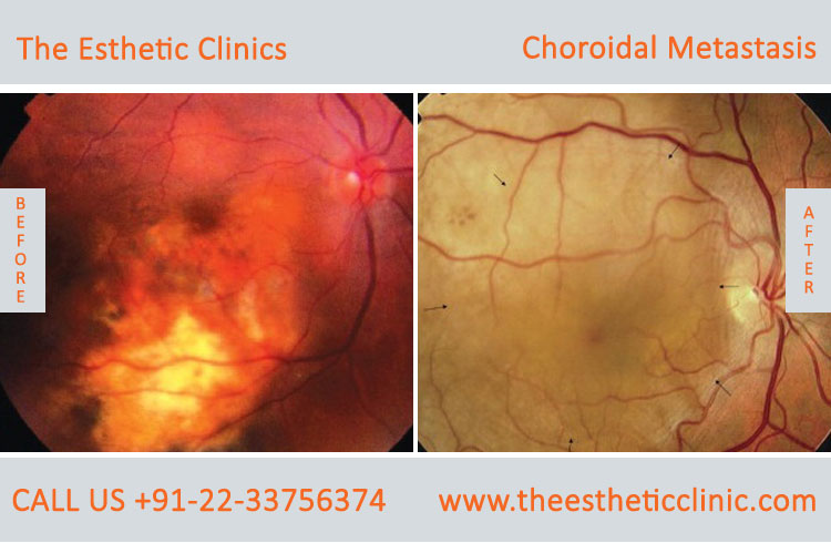 Choroidal Metastasis Eye Cancer Treatment before after photos in mumbai india (4)